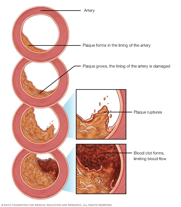 Development of atherosclerosis